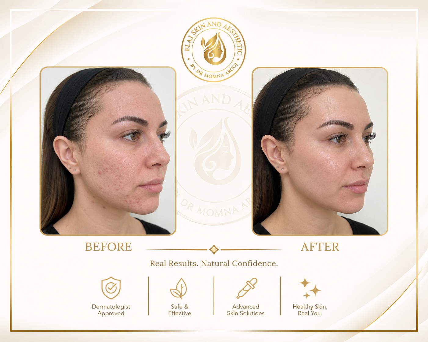 Before and after an ELAJ acne and skin-clarity programme